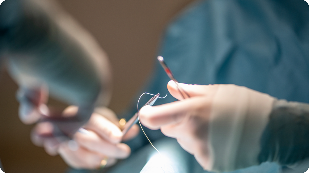 난치성 치질 수술