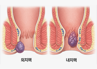 수분 섭취 부족