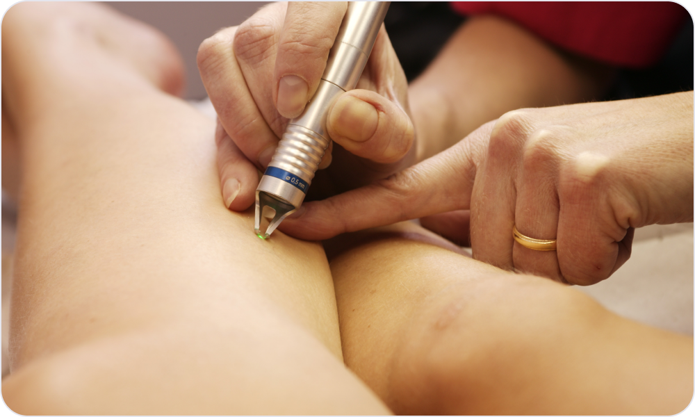 레이저 수술요법