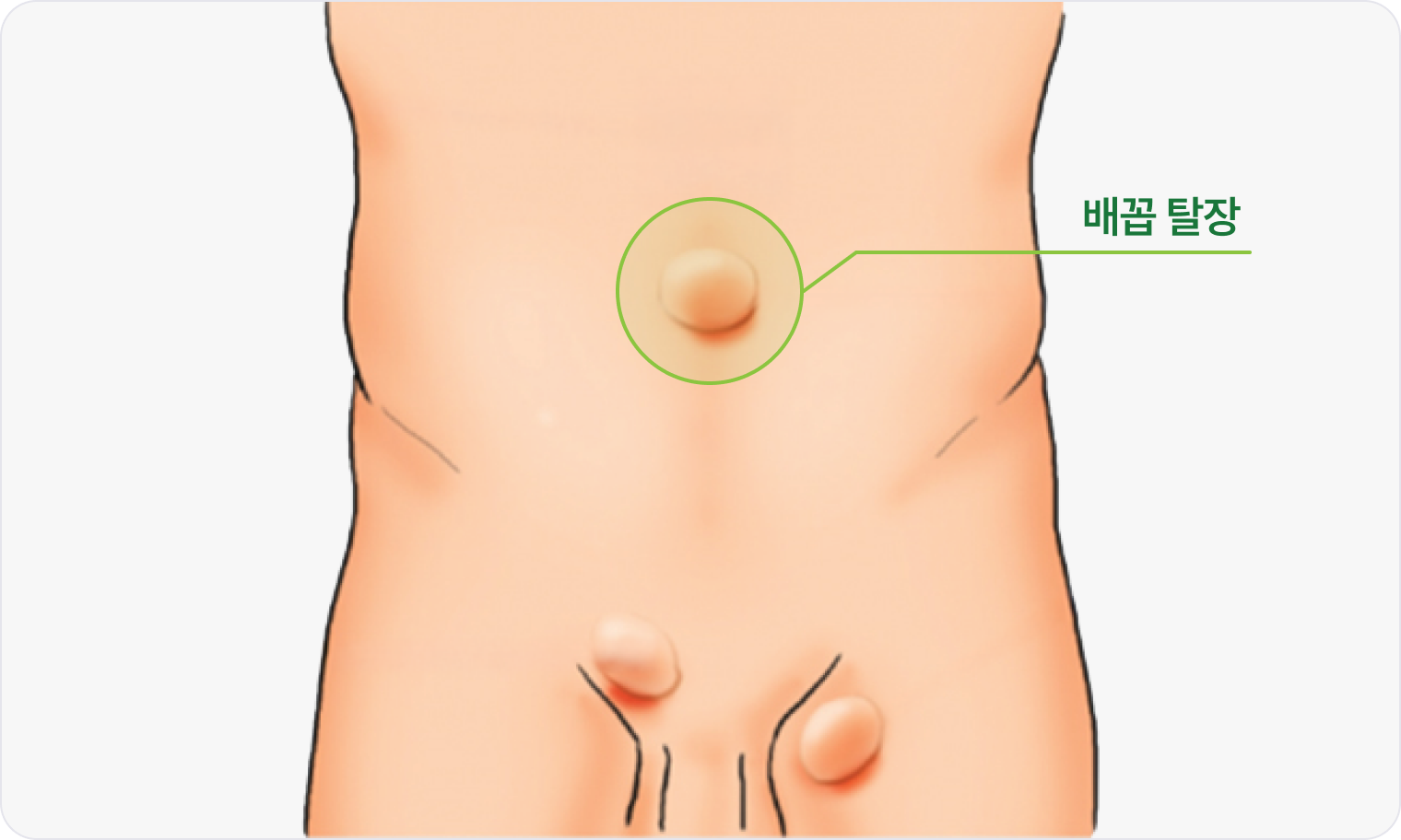 배꼽 탈장