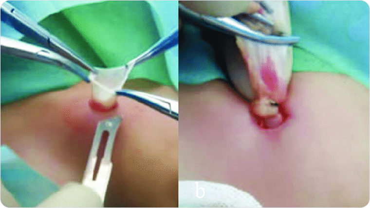 무인공망 고위결찰술